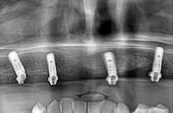 Before-импланти All-on-4